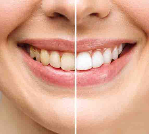 Combo Quita Manchas: Pulidor Dental + Obsequio Blanqueador